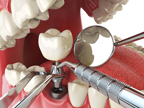 Best Broken or Chipped Tooth Repair in Alachua, FL